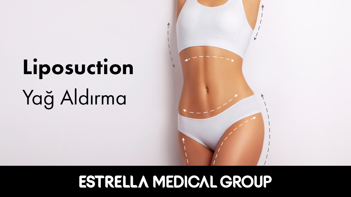 liposuction