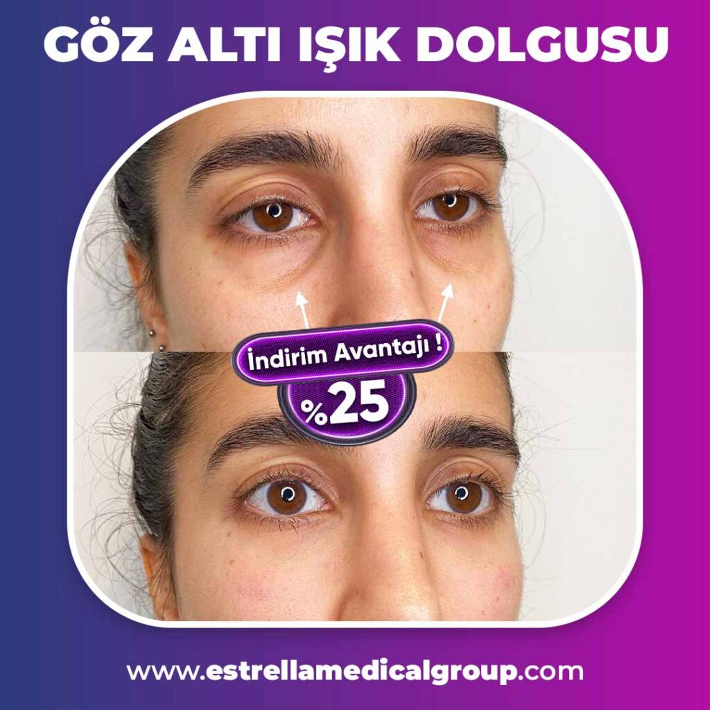 göz altı ışık uygulaması